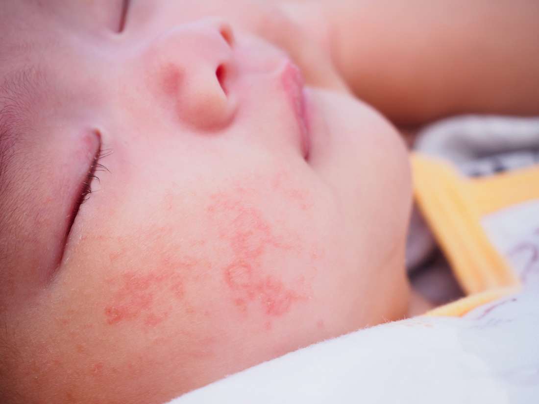 What Do Allergic Reactions Look Like On Babies