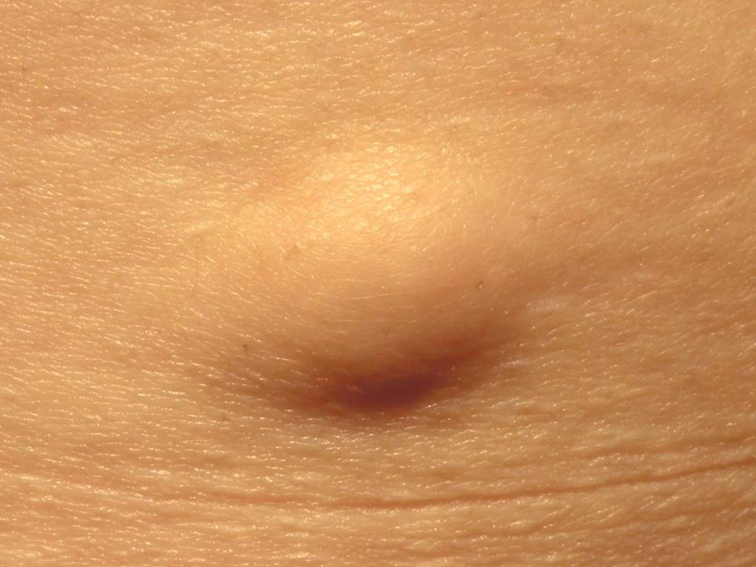 Lump near my vagina