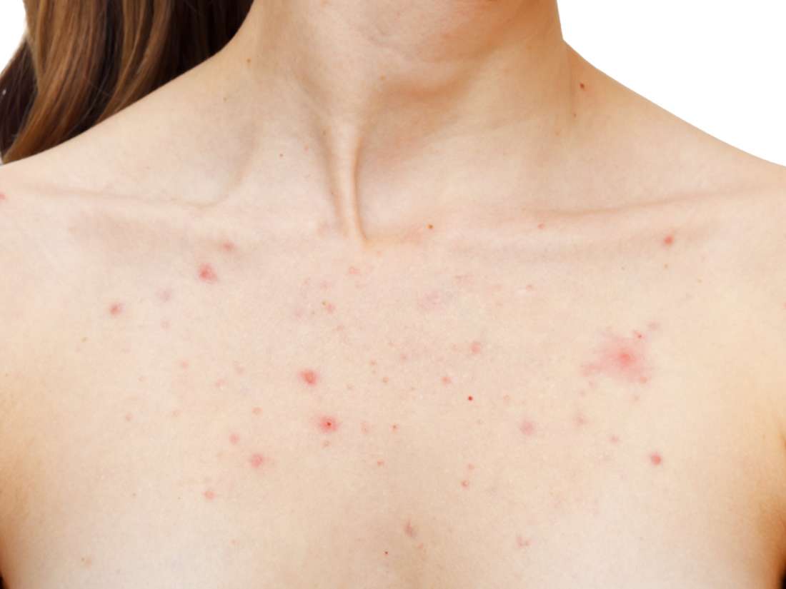 Pimples on breasts: Causes and how to get rid of them