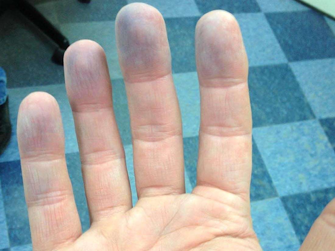 White Marks On Fingertips