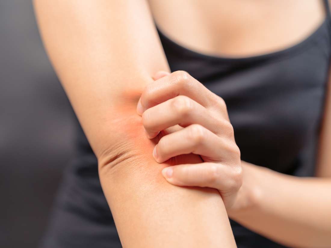 Does Menopause Cause Itchy Rashes