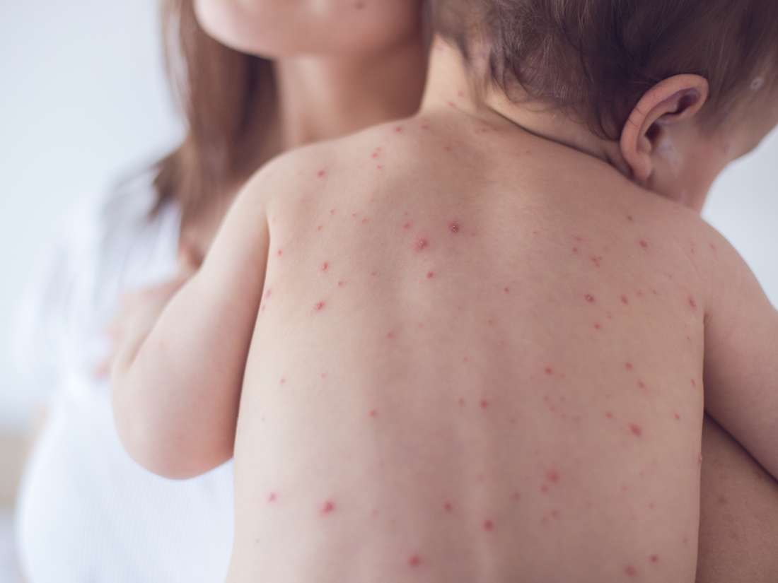 Chickenpox vs. measles: Symptoms, pictures, treatment, and more1100 x 825
