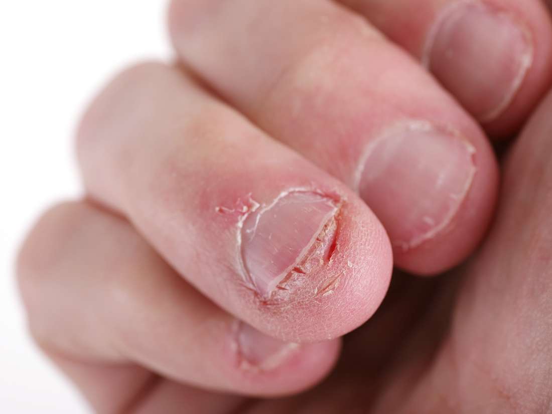 How To Get Rid Of Infection Under Nail