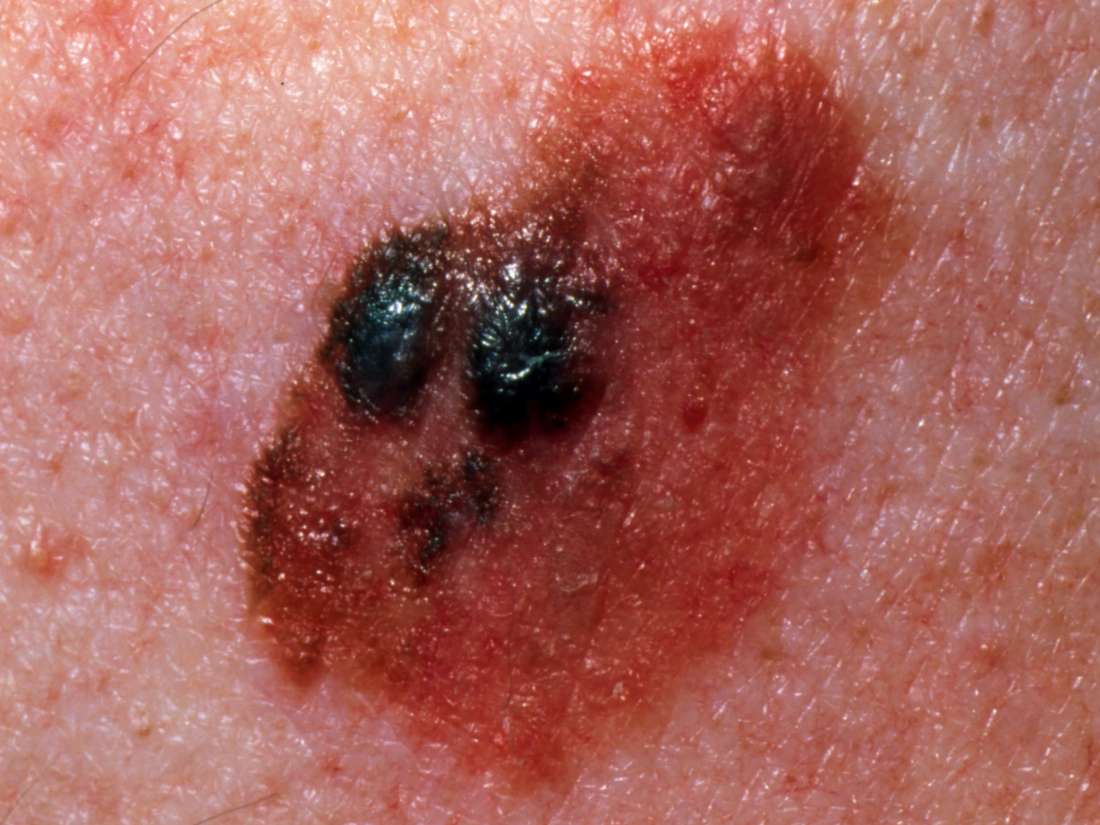 Life Expectancy With Malignant Melanoma