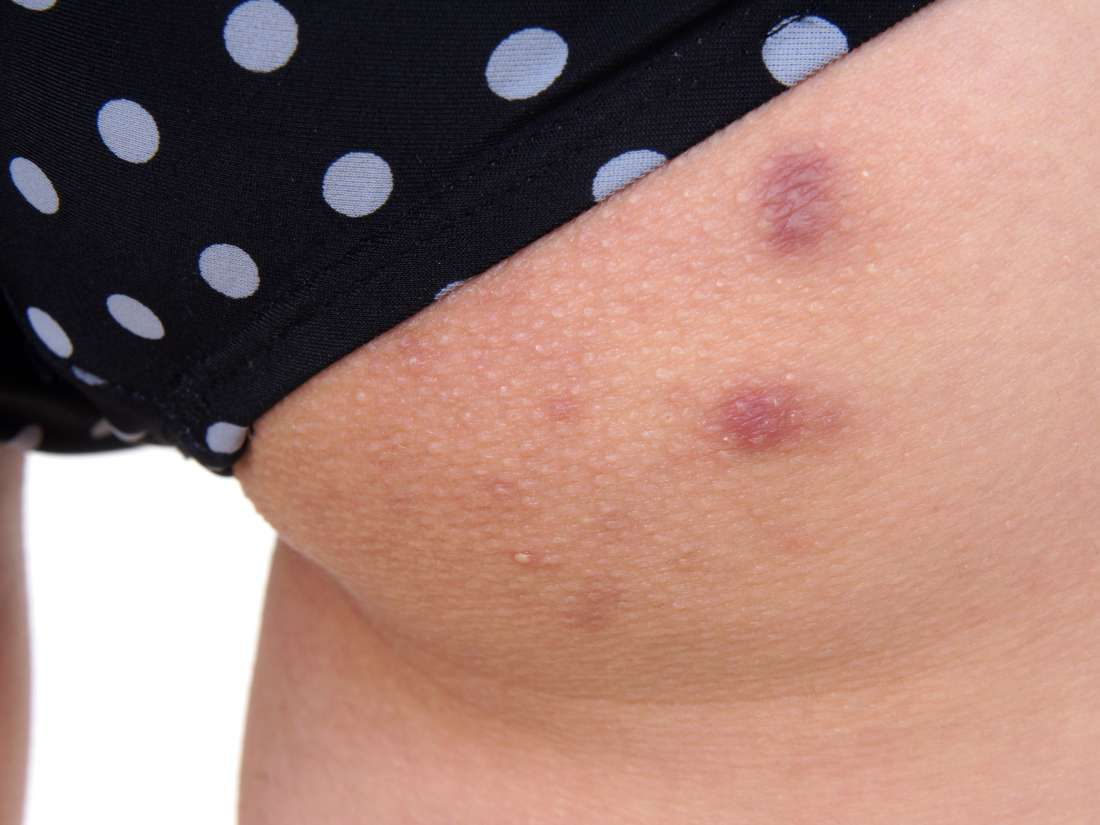 Hot Tub Folliculitis Pictures Symptoms Diagnosis Treatment