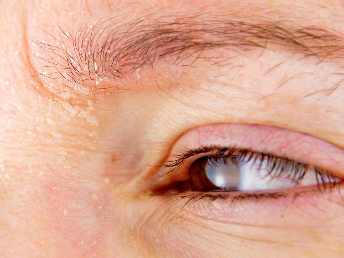 What Causes Redness Above Eyebrows