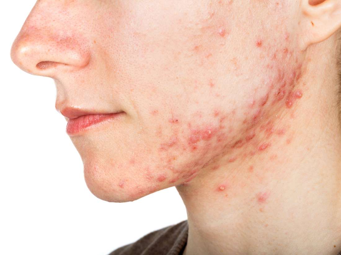 A new vaccine could wipe out acne