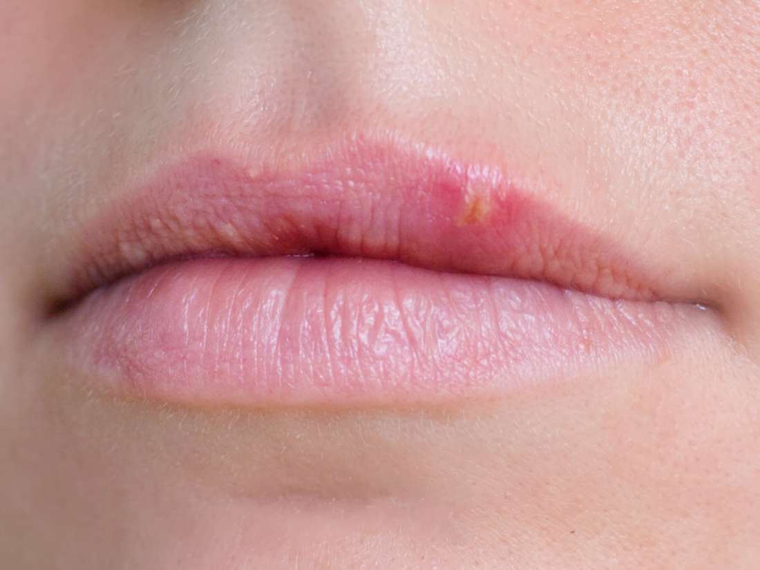 Red spots on roof of mouth: Causes and other symptoms