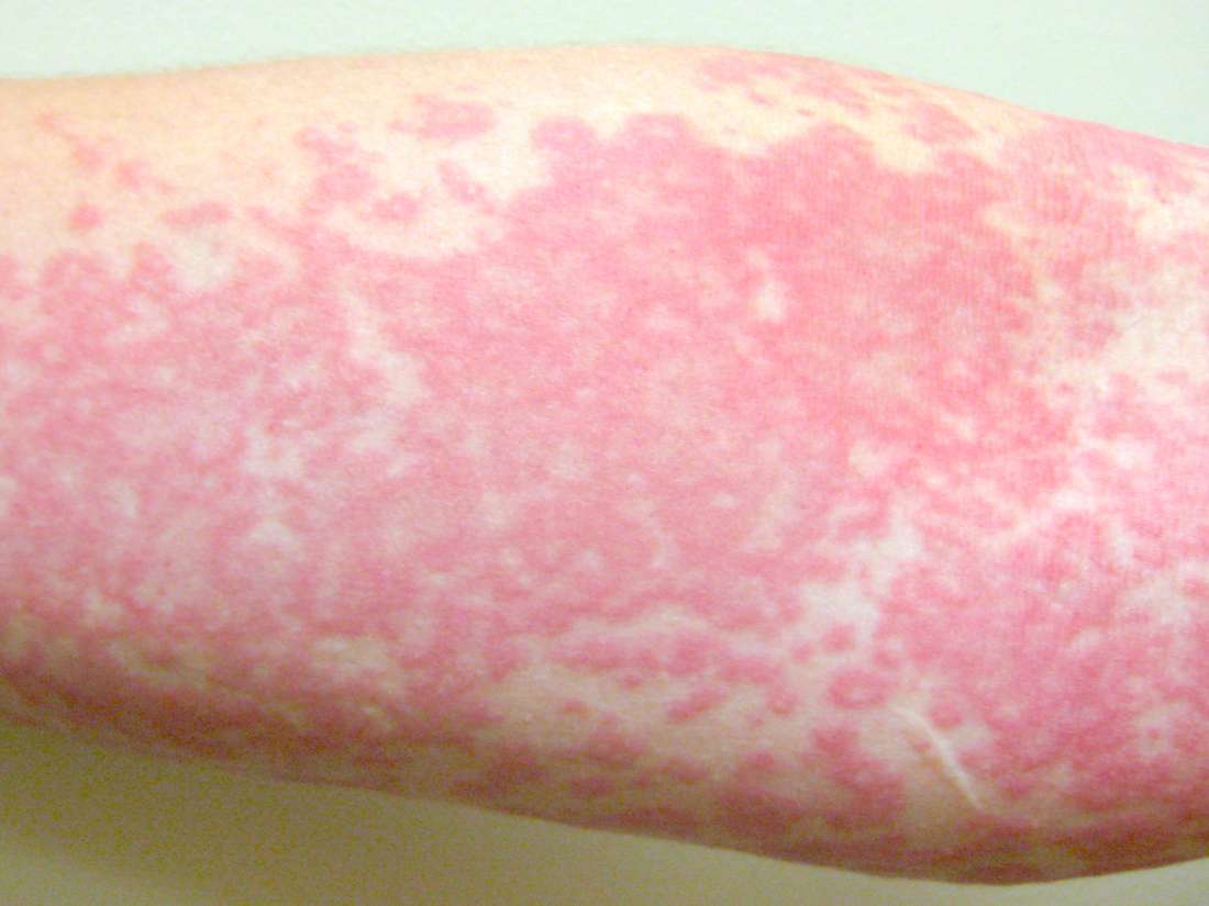 Hot Tub Folliculitis Pictures Symptoms Diagnosis Treatment