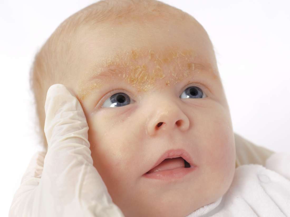 Rash on a baby's face Pictures, causes, and treatments