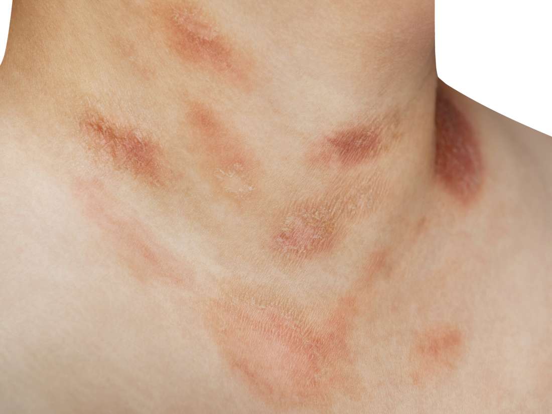 Psoriasis Vs Pityriasis Rosea Symptoms And Causes