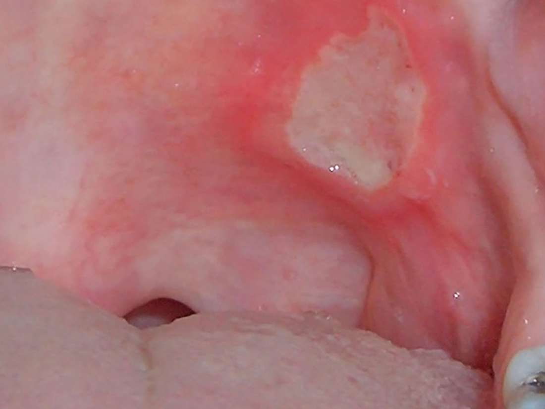 Crohns Mouth Ulcers Symptoms Causes And Treatments