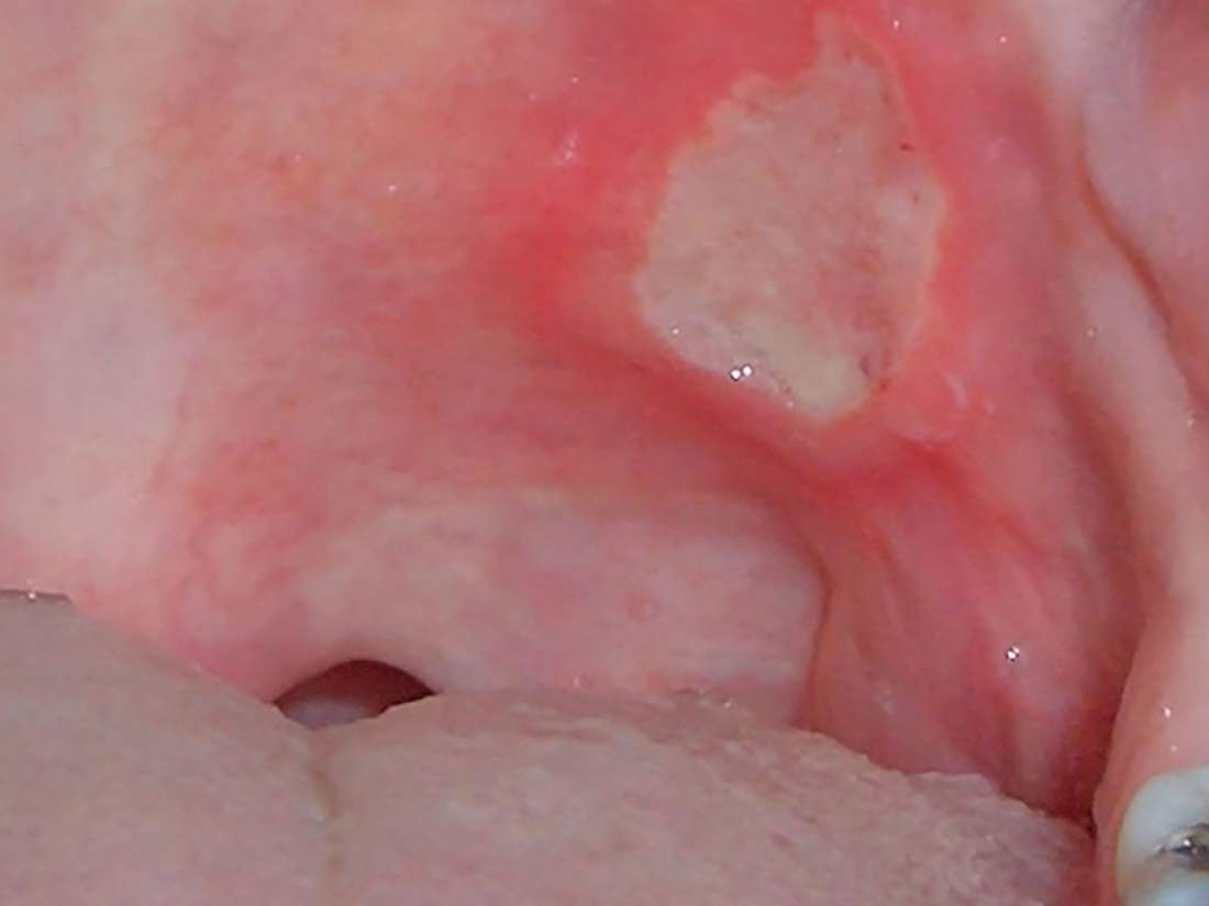 mouth-ulcers-on-tongue