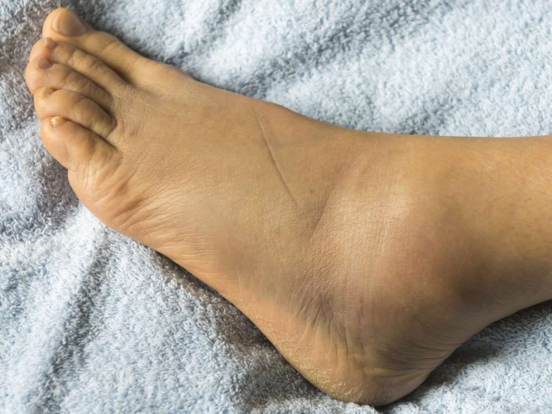 What Causes Swollen Ankles And Painful Feet