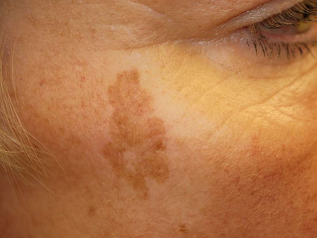 pictures of skin spots