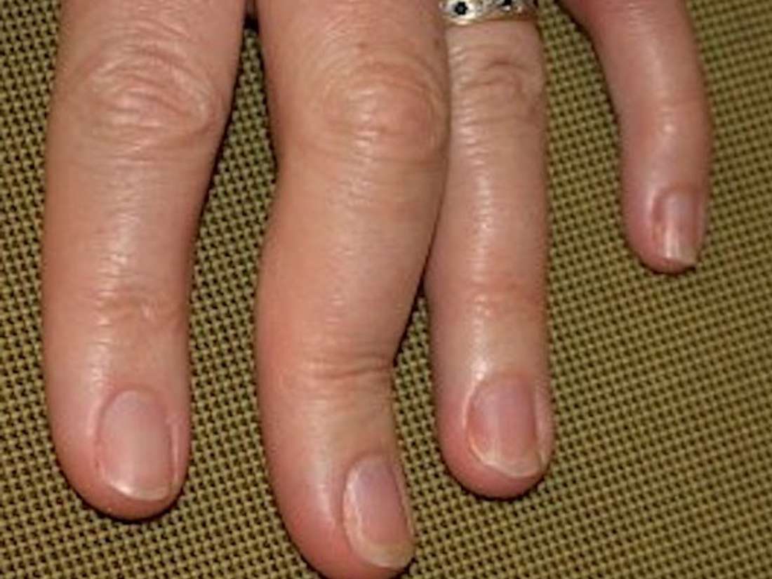 Psoriatic arthritis in the hands Symptoms, pictures, and treatment