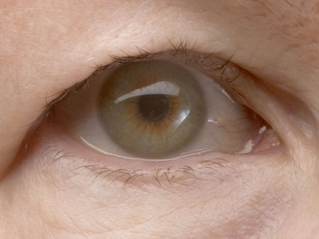 Droopy Eyelid ptosis Causes Risk Factors And Treatment