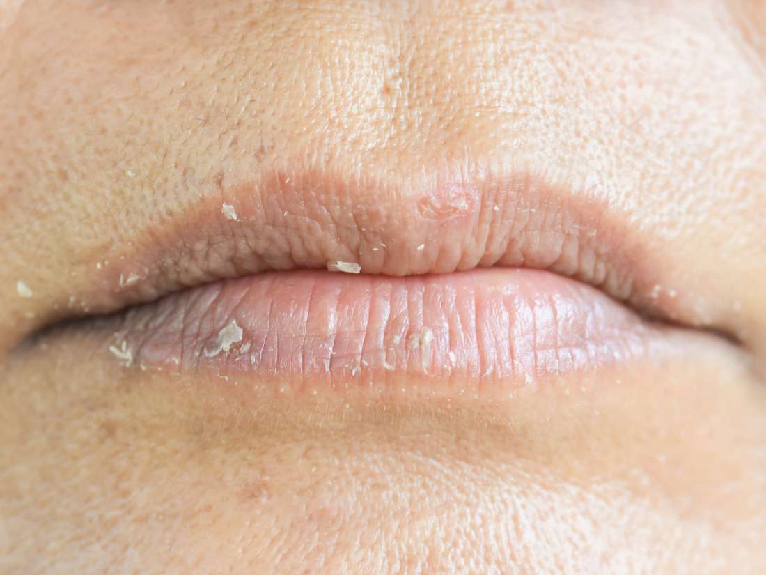 Treatment for rash around mouth