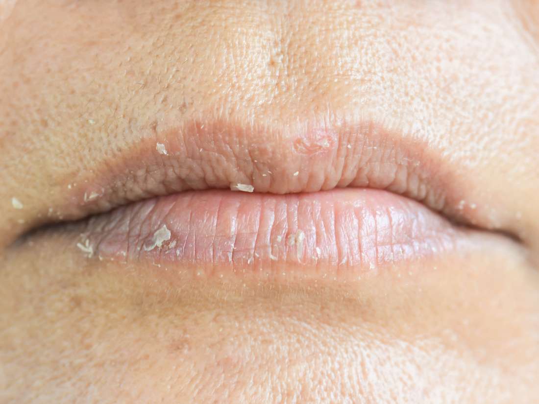 Rash On Lips Pictures - PictureMeta