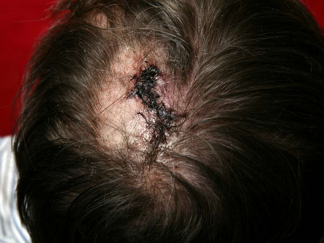 Sores and scabs on scalp: Pictures, causes, and treatment