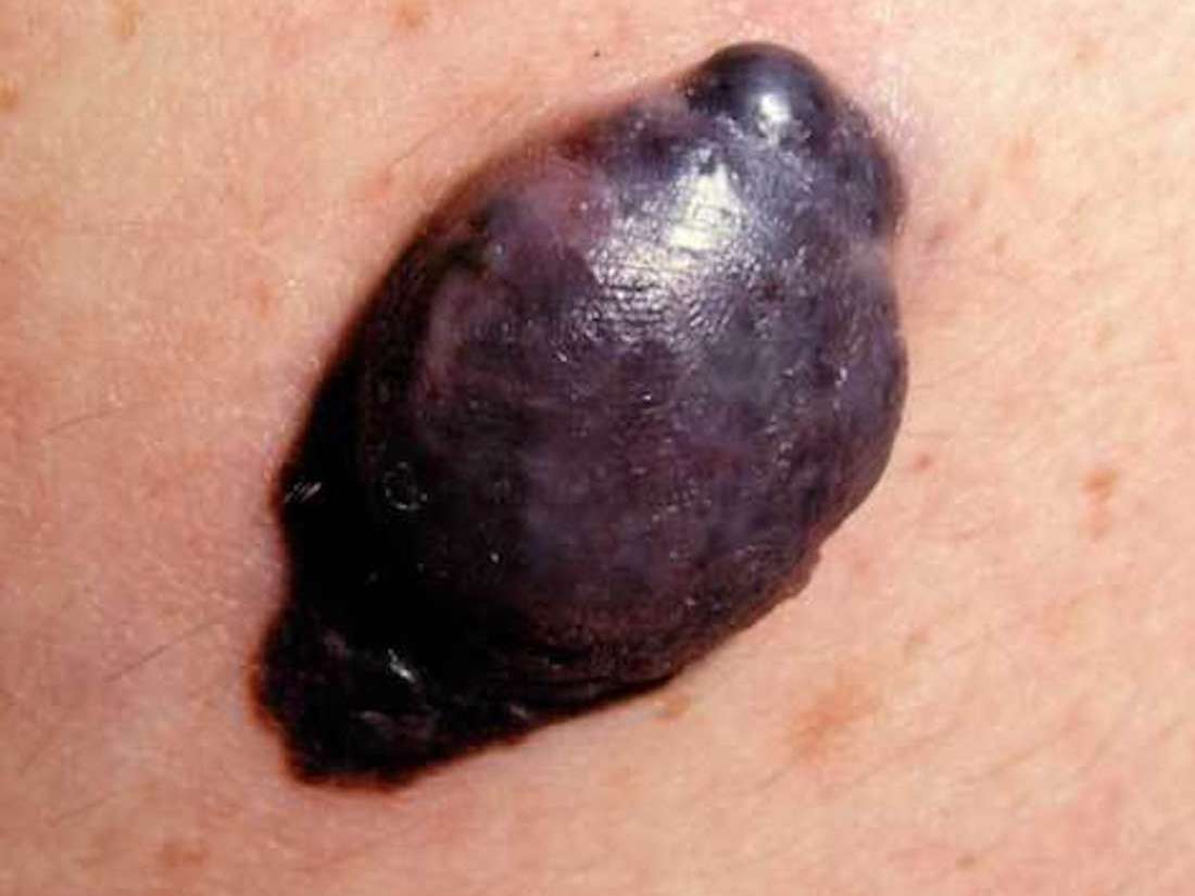 Nodular melanoma: Symptoms, risk factors, diagnosis, and treatment