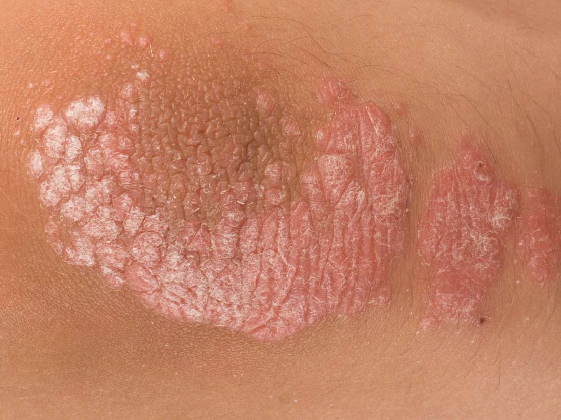 plaque-psoriasis-armpit