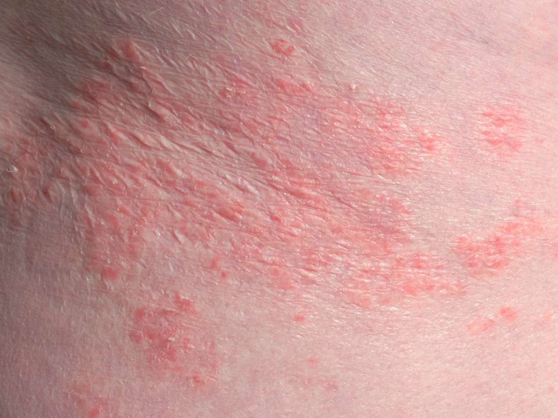 itchy rash in groin area female