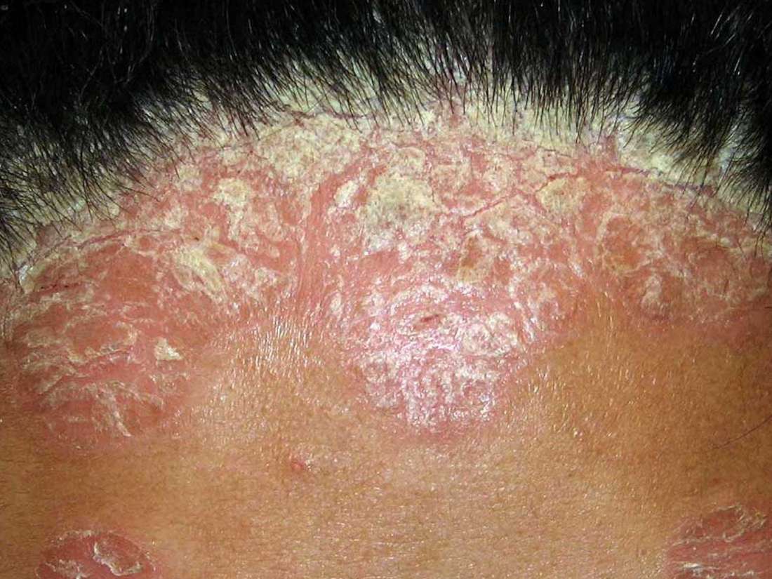 Scalp Psoriasis Pictures Symptoms And Treatment