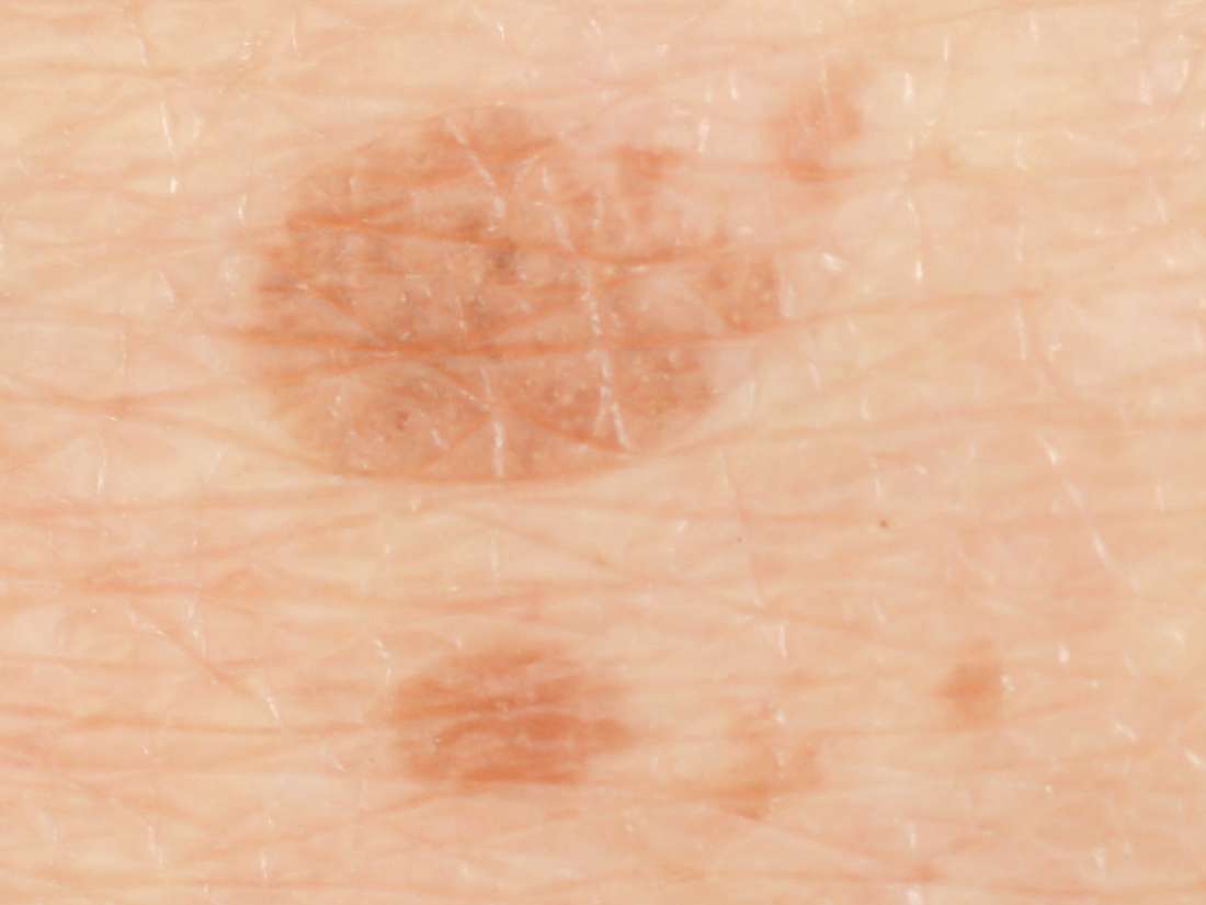 what-causes-sudden-dark-patches-on-your-skin-dermaconcepts