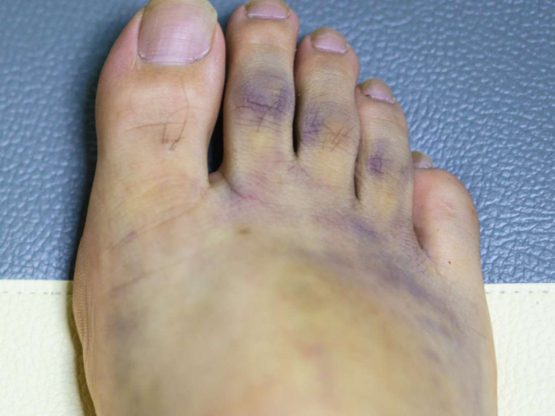 what-causes-purple-toe-at-santos-douglas-blog