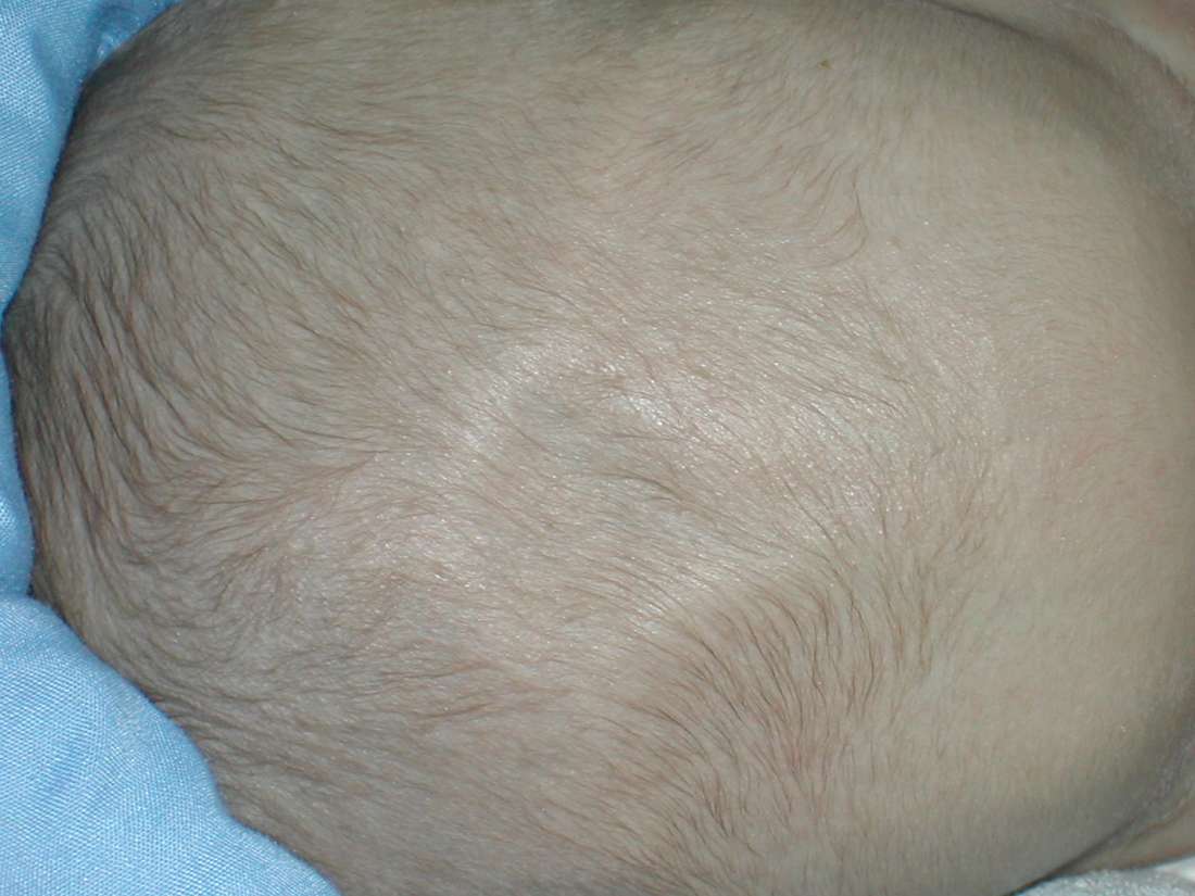 Sunken fontanel Causes, picture, and complications