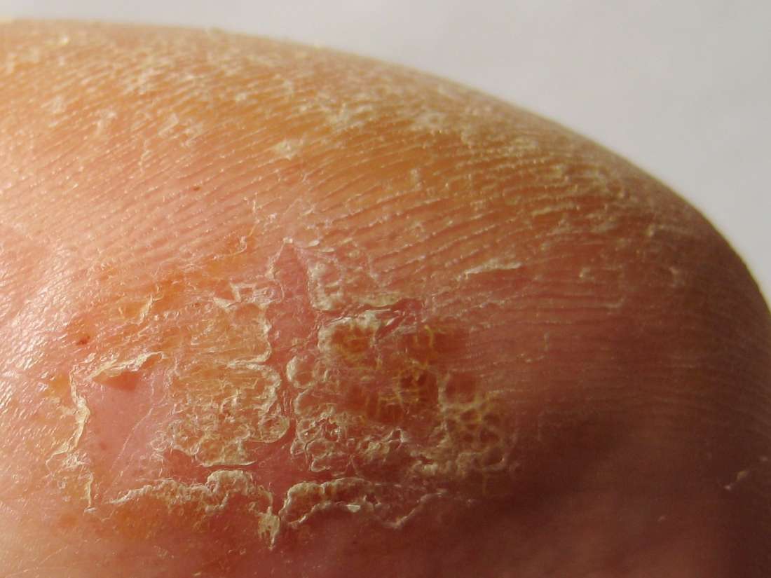 What Does It Mean When Your Skin Is Flaking