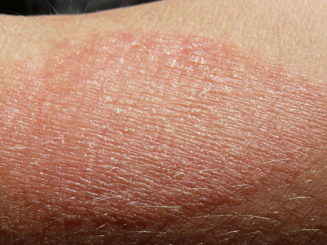 Patches Of Scaly Dry Skin