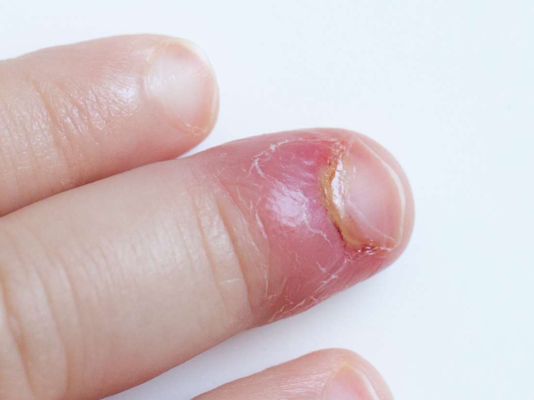 Painful Skin On Side Of Fingernail