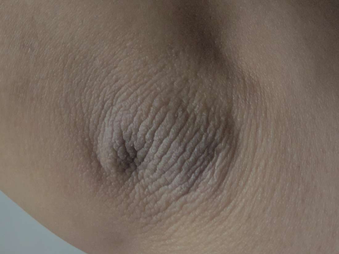 Acanthosis Nigricans Causes Symptoms Treatment And Pictures