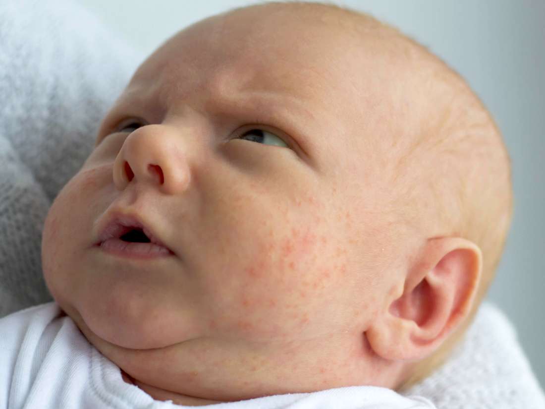 Red Rash On 10 Month Old Baby Face