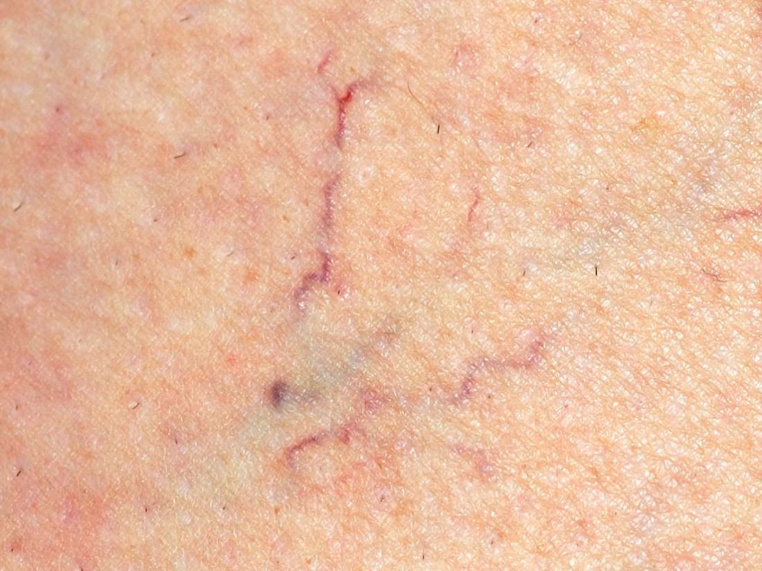 Spider veins: Causes, treatment, and prevention
