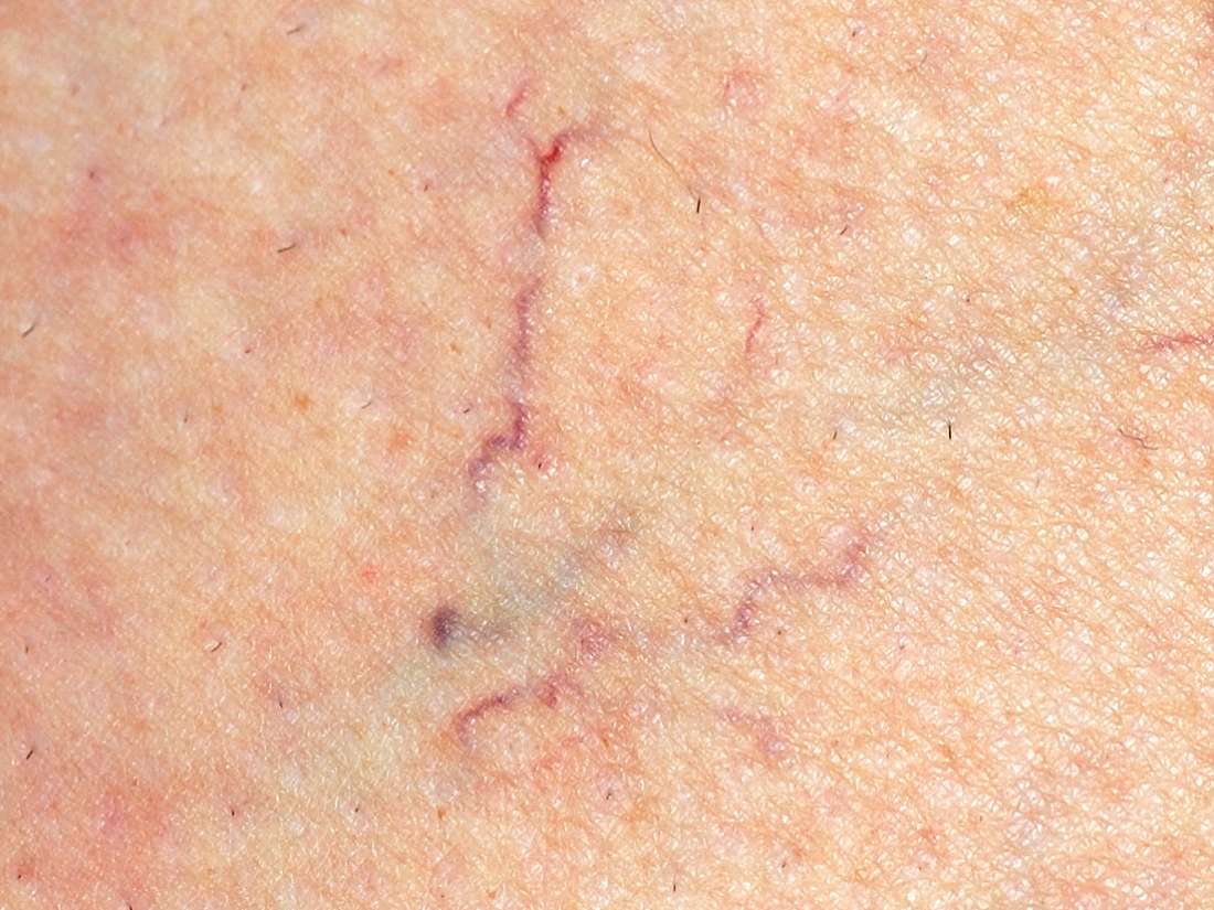 Spider veins: Causes, treatment, and 