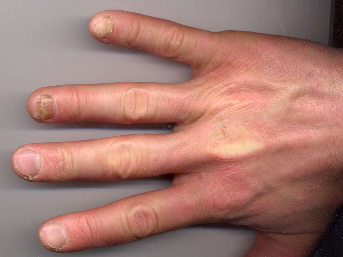 psoriatic-arthritis-and-nails-changes-pictures-and-treatment