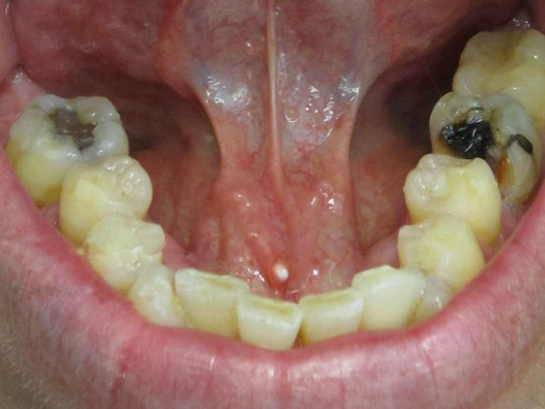 dry-mouth-causes-symptoms-and-treatment