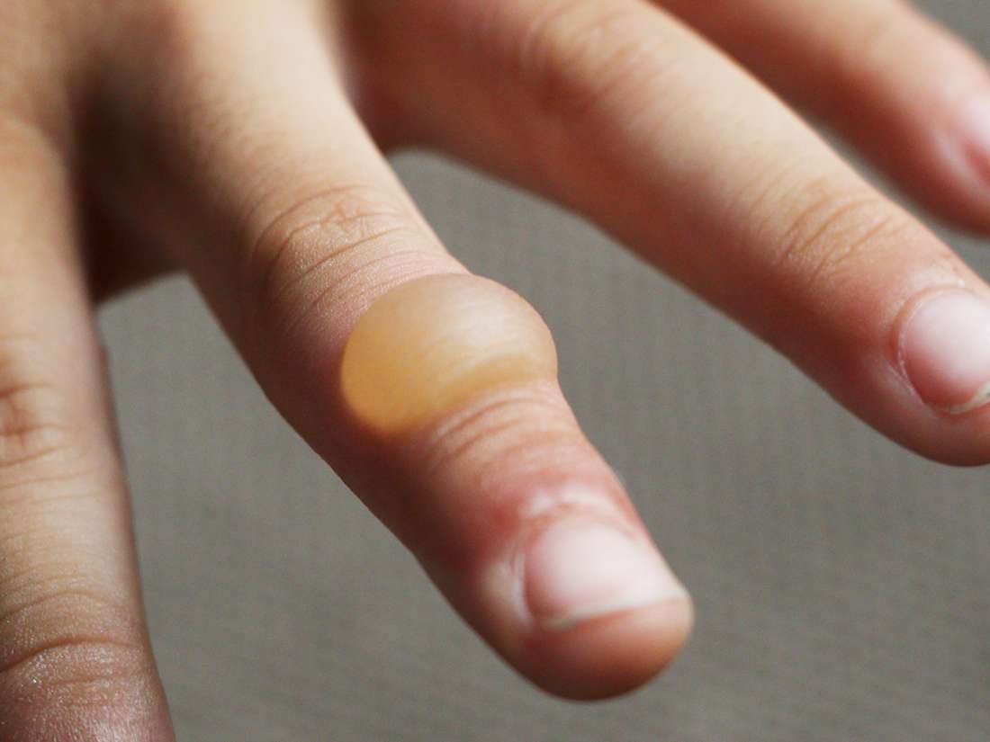 Burn blister: First aid, treatment, and types of burns