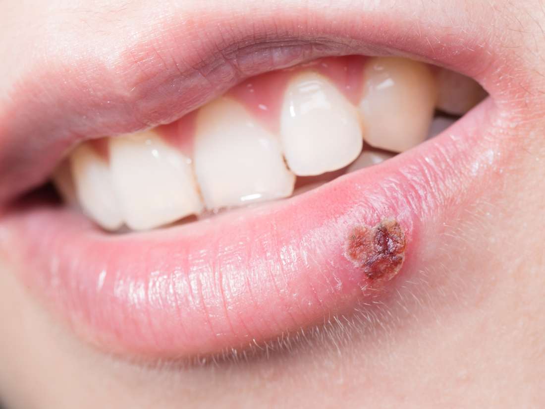 Do Cold Sores Hurt When Forming