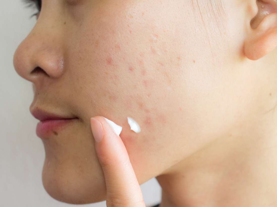 Reasons For Acne Chart