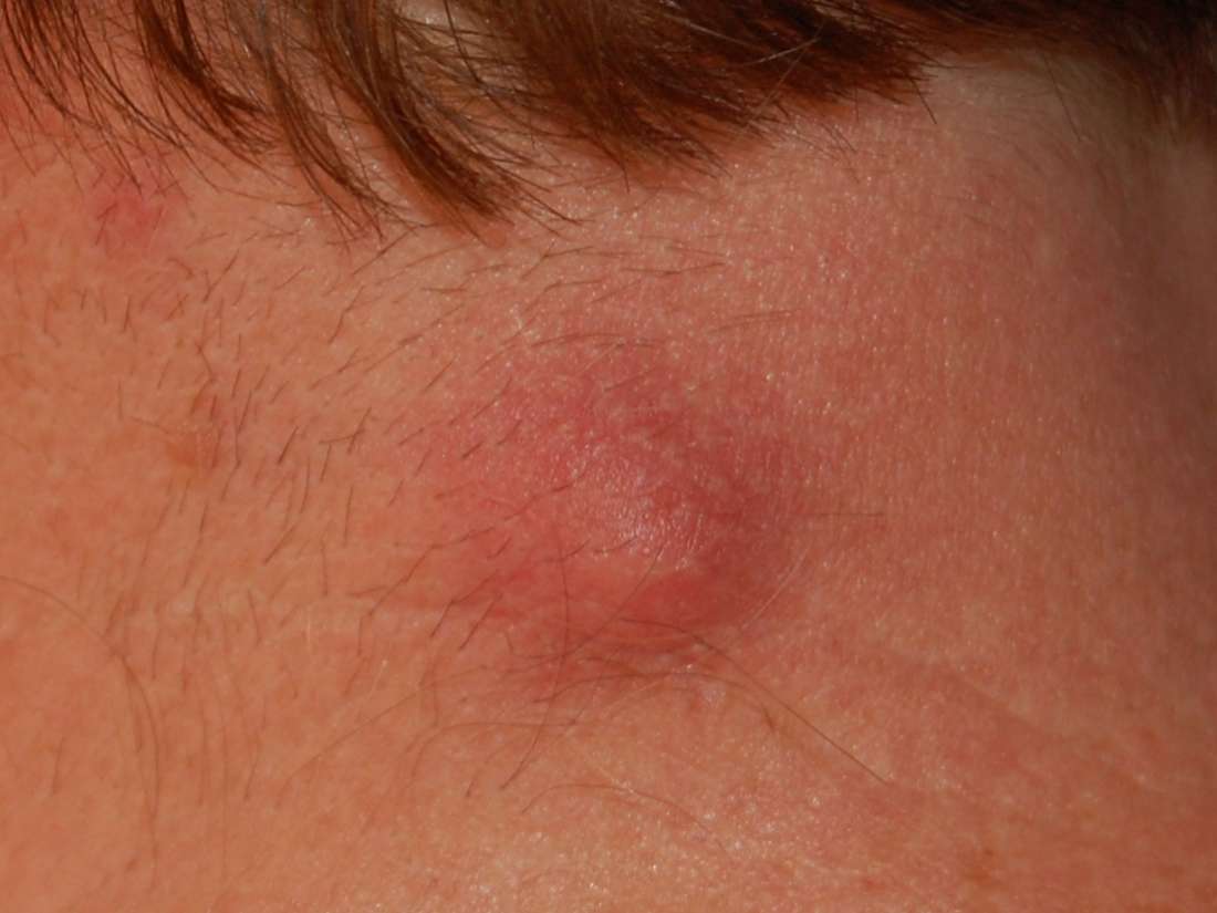 Lump on neck: Causes and pictures