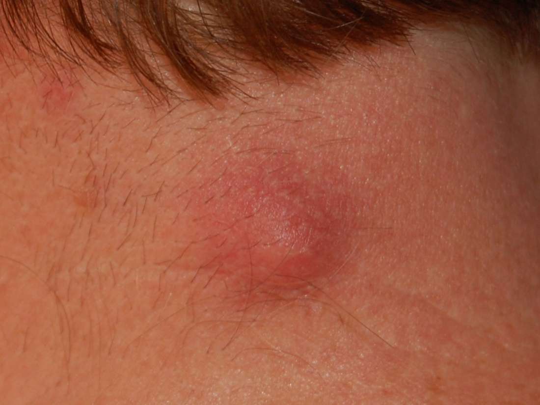 Hard Lump Under The Skin Causes And Pictures