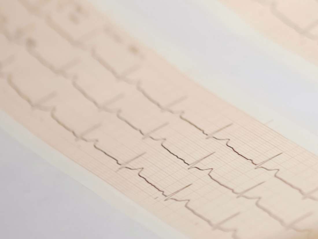 abnormal-ekg-results-causes-and-treatment