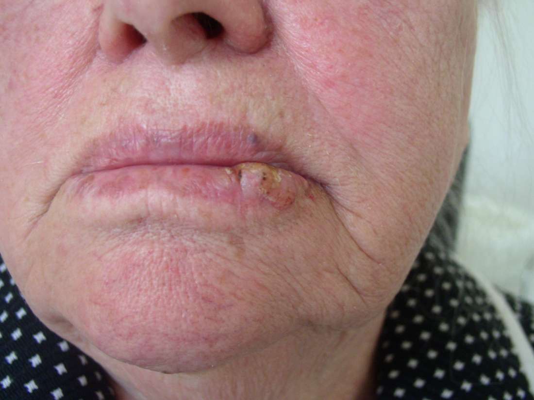 Lip Cancer What It Looks Like And What To Do