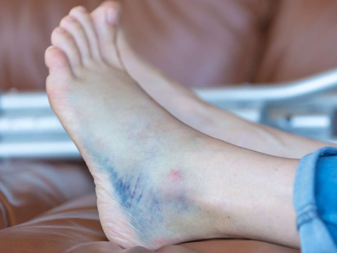 bruised-heel-remedies-and-when-to-see-a-doctor