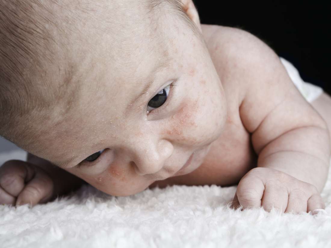 Dry skin on a baby's face: Causes and remedies