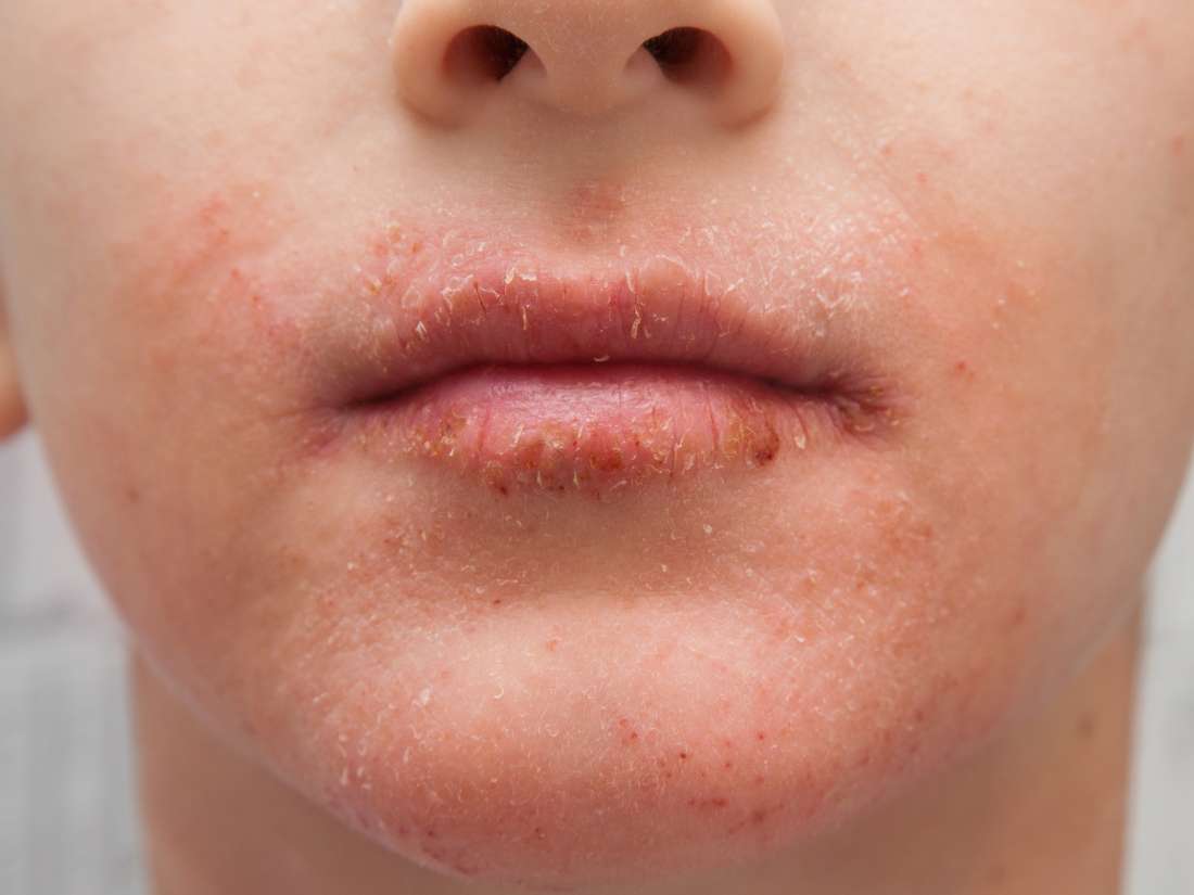 What Causes Red Skin Around Mouth